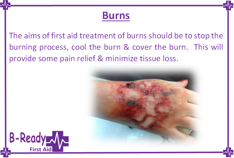 First aid initial treatment of burns by B-Ready First Aid, training business and general public in Brisbane Queensland Australia