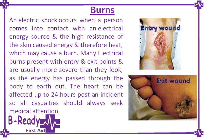 Identifying  Electrical burns & first aid about what to look out for by B-Ready First Aid