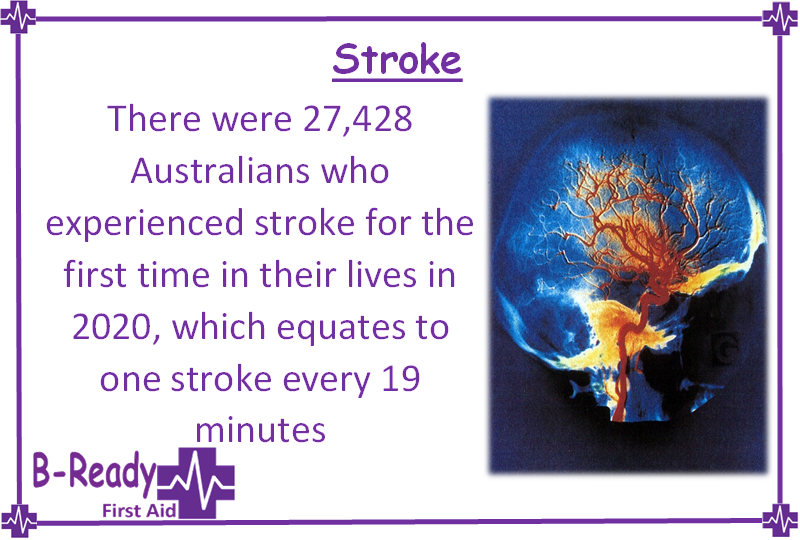 2020 stroke statistics= 1 stroke every 19 min in Australia 